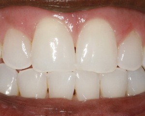 After Aesthetic Smile Enhancement Patient 2