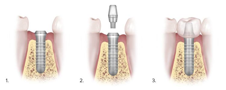 Graphic Showing 3 Steps to Dental Implant Process with Dr. Anson in Beverly Hills