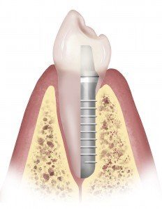 Drawing of Dental Implant Superimposed on Tooth