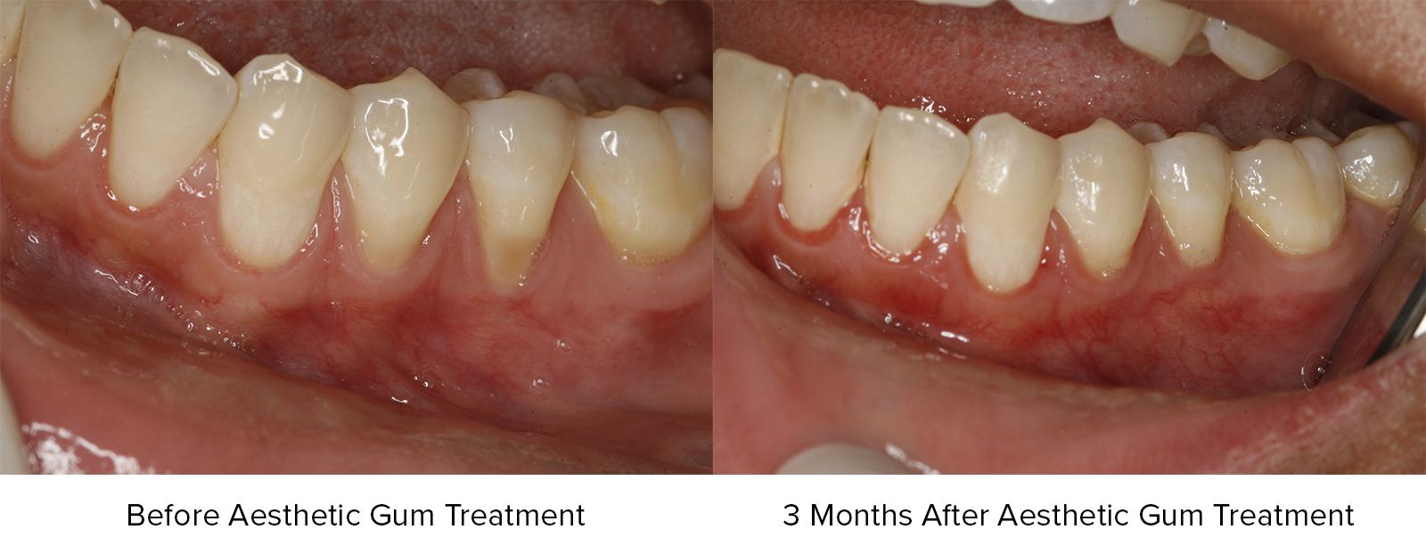 Before Aesthetic Gum Treatment and 3 Months After Aesthetic Gum Treatment Photos