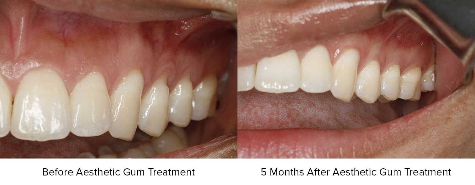 Before Aesthetic Gum Treatment and 5 Months After Aesthetic Gum Treatment Photos